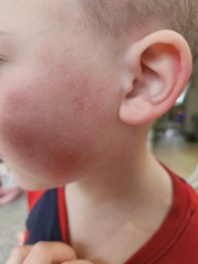 Rash help