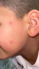 Could this be chicken pox or any idea what else it could be