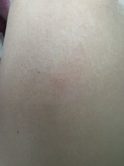 To ask for help with what is biting me?