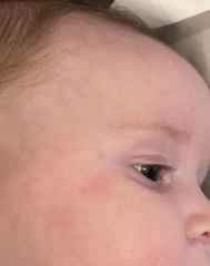 Little bruise and random single petechia that comes and goes