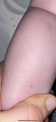 Little bruise and random single petechia that comes and goes