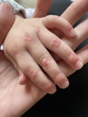 2 year old rash