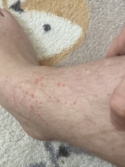 Rash on legs help.