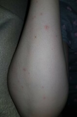 What is biting me?