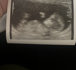 Can anyone see a nub on these scans?