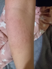 Rash help