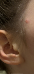Chicken pox ???