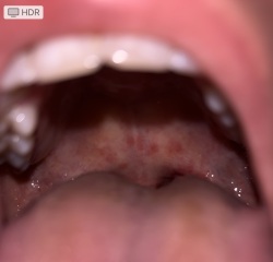 Mouth and throat ulcers - pics attached.
