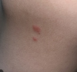 What is biting me?!