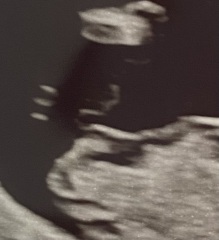 What is this rounded nub on my 13 week scan???