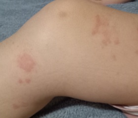 Rash help