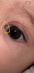 Blocked tear duct or conjunctivitis?