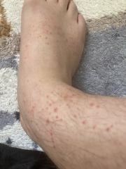 Rash on legs help.