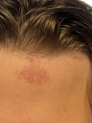 Eczema? Can you help ID this random patch please.