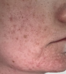 My skin is ruining my life and I’m only 27