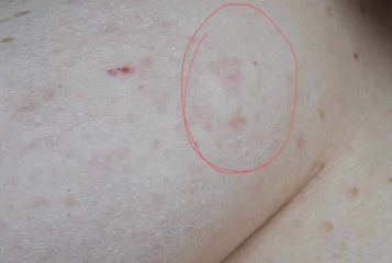 Extremely worried about this rash on my boob. IBC? Photos