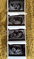 First ultrasound