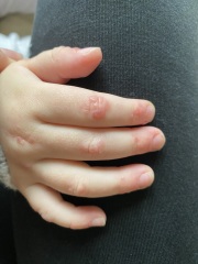 2 year old rash