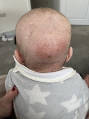 Rash back of head