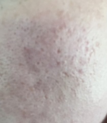 My skin is ruining my life and I’m only 27