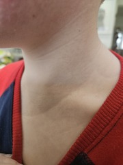 Rash help
