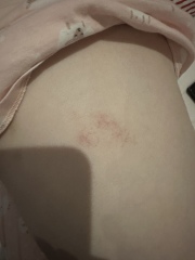 Rash but no other symptoms