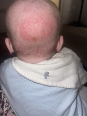 Rash back of head