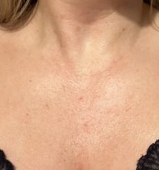 To ask what this rash could be..??