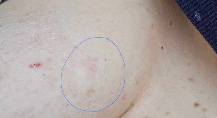 Extremely worried about this rash on my boob. IBC? Photos
