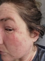 Almost constant herpes simplex on my face