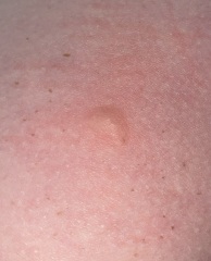 What is biting me?!