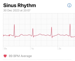 What’s going on with this ECG (Apple Watch)