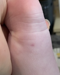Little bruise and random single petechia that comes and goes