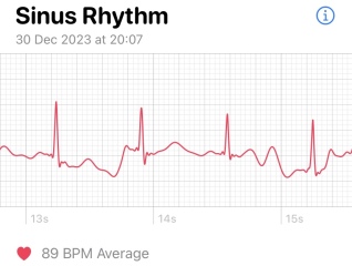 What’s going on with this ECG (Apple Watch)