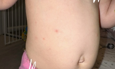 Random spots allergy?