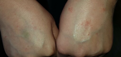 What is biting me?