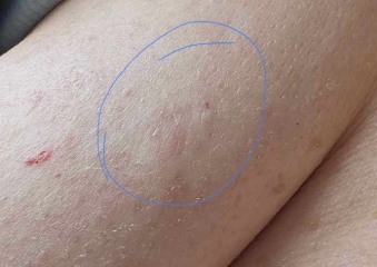 Extremely worried about this rash on my boob. IBC? Photos