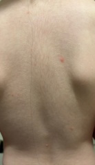 Chicken pox ???