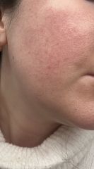 Does this look like rosacea?