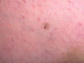 To ask you if this mole would worry you (sorry)