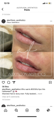 Lip fillers?