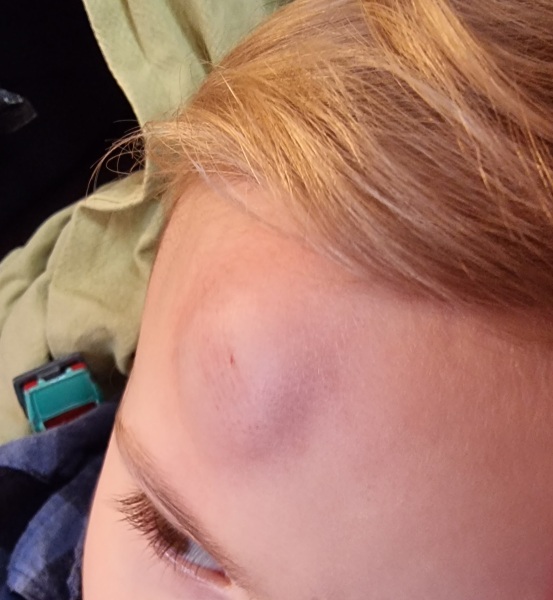 3 y o head injury a&e?