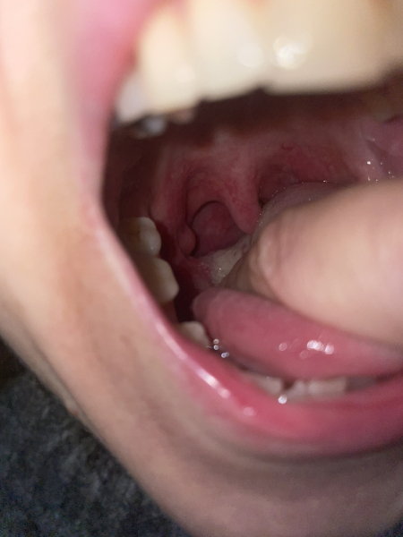 Potential tonsil cyst