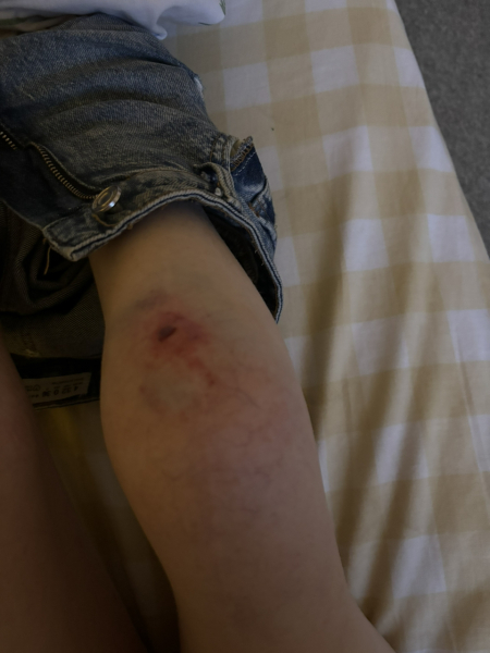 Sorry for posting AIBU, but could this cut need stitches??