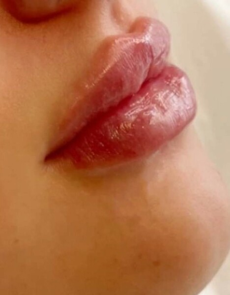 How can filler have permanently changed my lips?