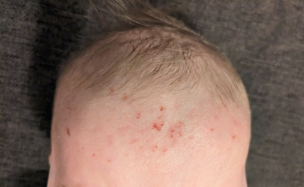 Eczema? Worried about 9mo skin (photos)