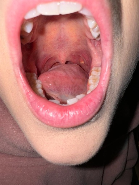 Lump on throat. Cancer? 