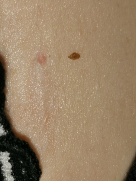 What the heck was this in my scar? (bit gross)