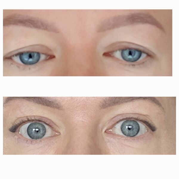 Upper Blepheroplasty