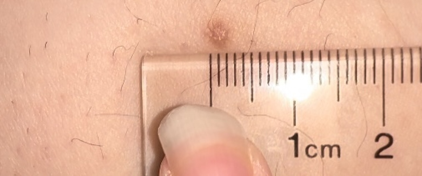 Dermatofibroma